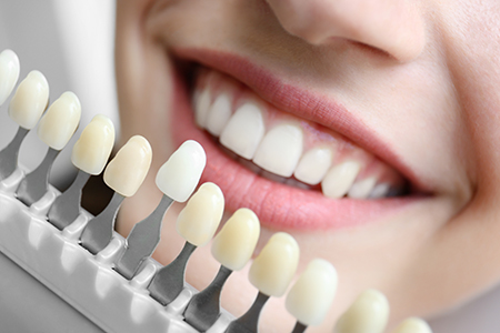 Dental veneers are tooth coloured facings that cover stains and imperfections