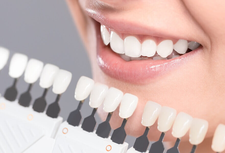 Leichhardt Dental Uses Teeth Whitening Shade Guide On Patient